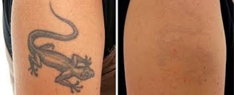 Free Tattoo Removal Clinic! | Oxnard