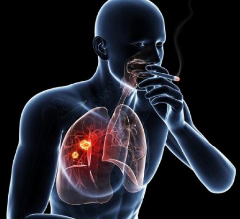 Assess Your Lung Cancer Risk and Learn About New Treatments at a Free CMHS Seminar on July 31
